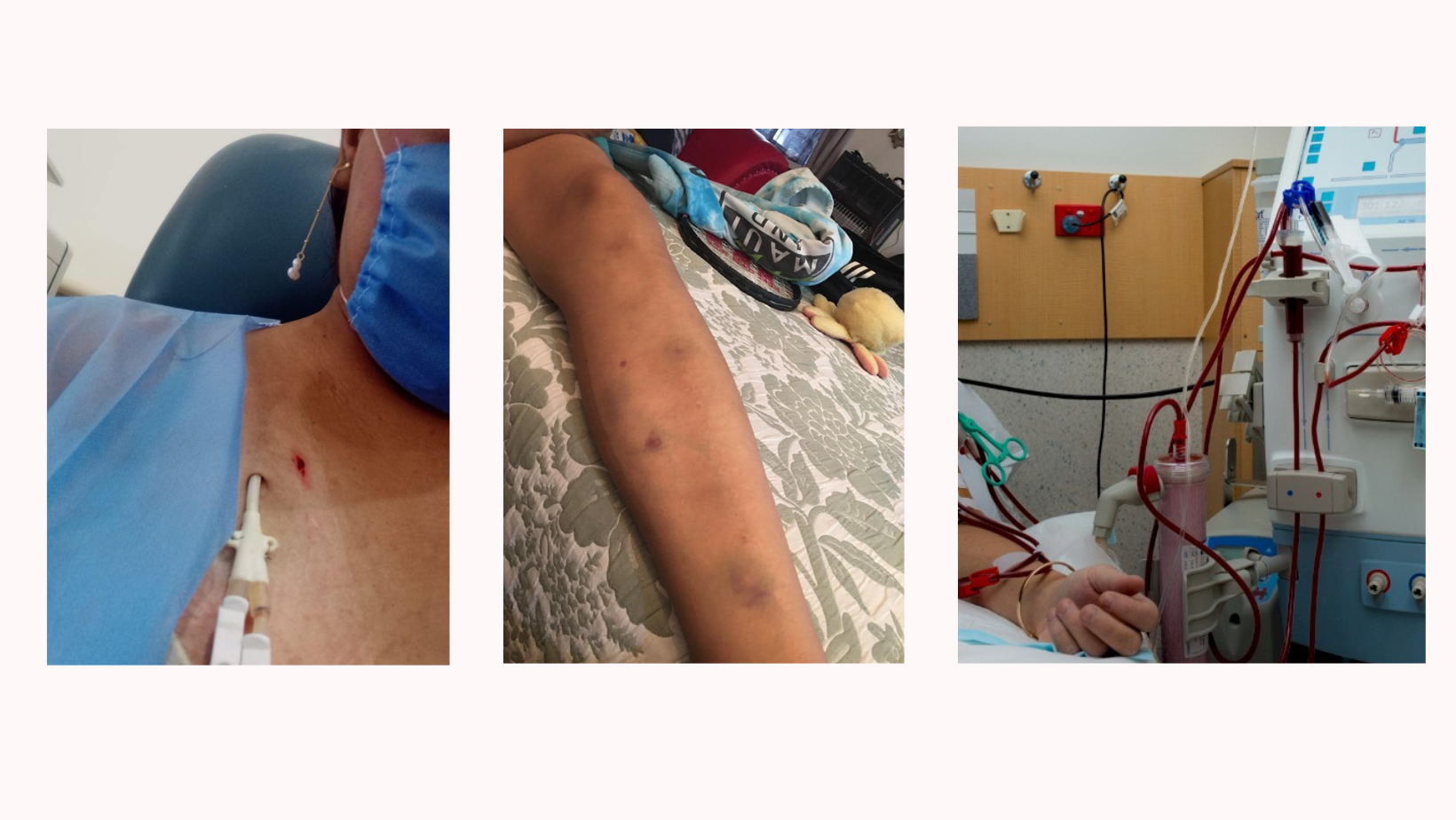 Liliana solicita apoyo de la comunidad para realizarse cambio de catéter